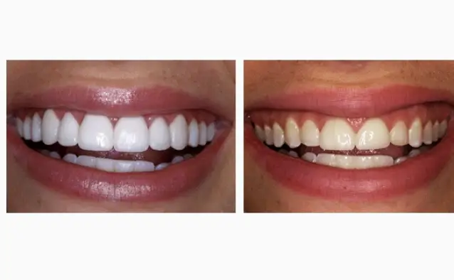 Young Family Dental Riverton