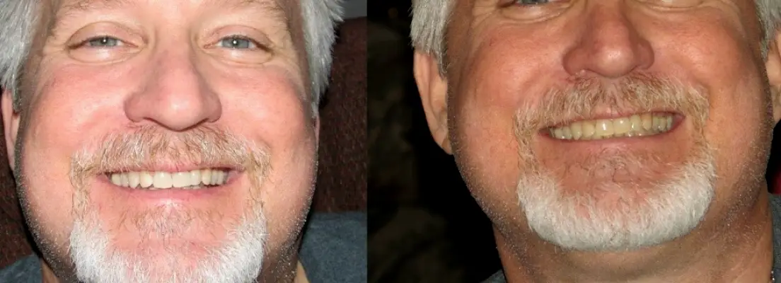 Tallahassee SmileLabs Teeth Whitening