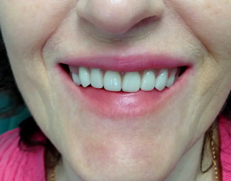 Garfield Zirconia Crown NJ