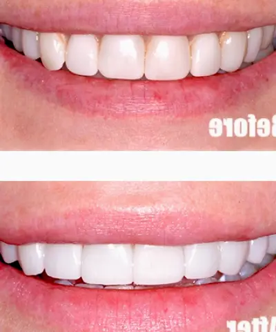Granada Hills Expert Veneers