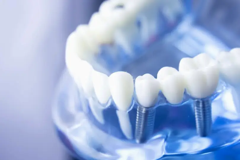 Feasterville-Trevose Dentist Implants Bucks County