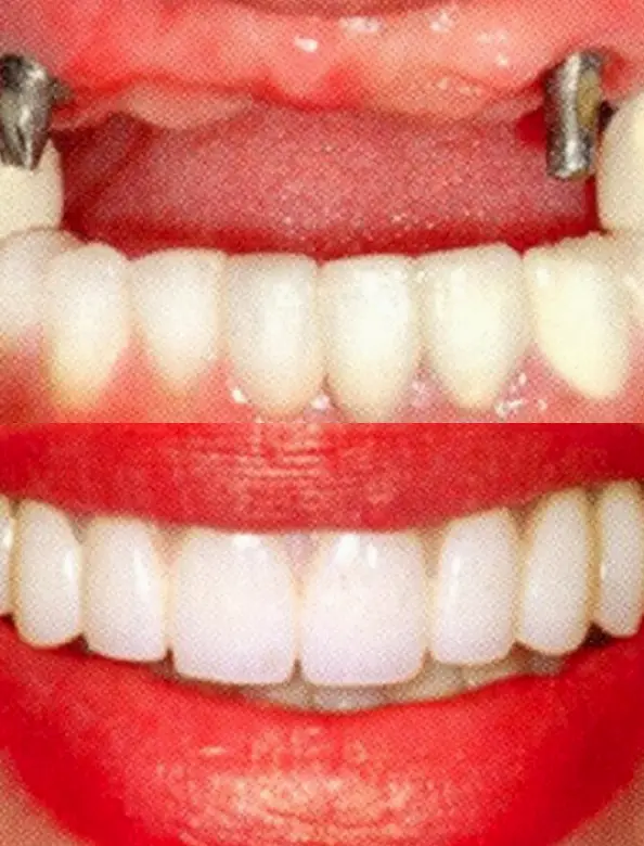 Boca Raton Boca Perio Implants: Dr. Julian C. Leichter, DMD