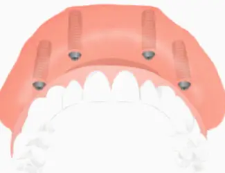 Dental Implant Solutions Kinnelon, NJ