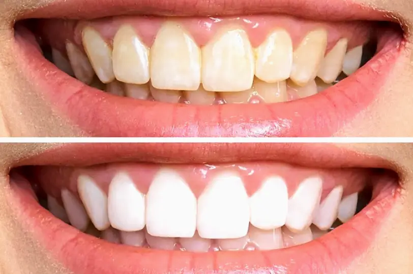  North Miami White Teeth Miami