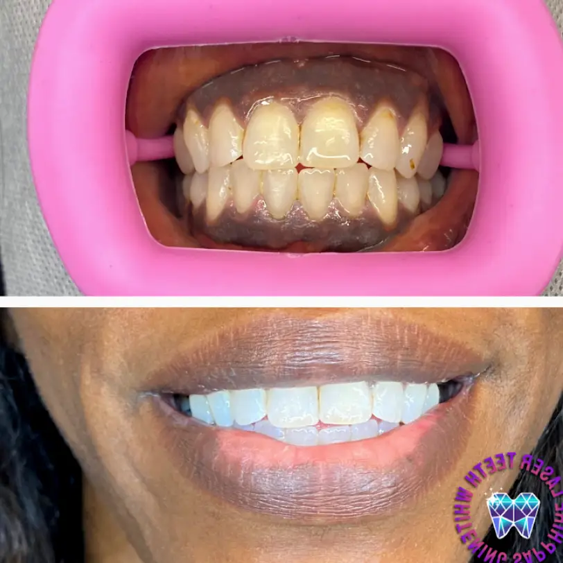 Hazelwood SapphireLaserTeethWhitening