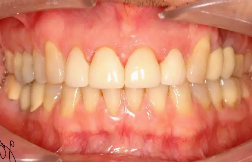 Weslaco Dental Implants and Prosthodontics