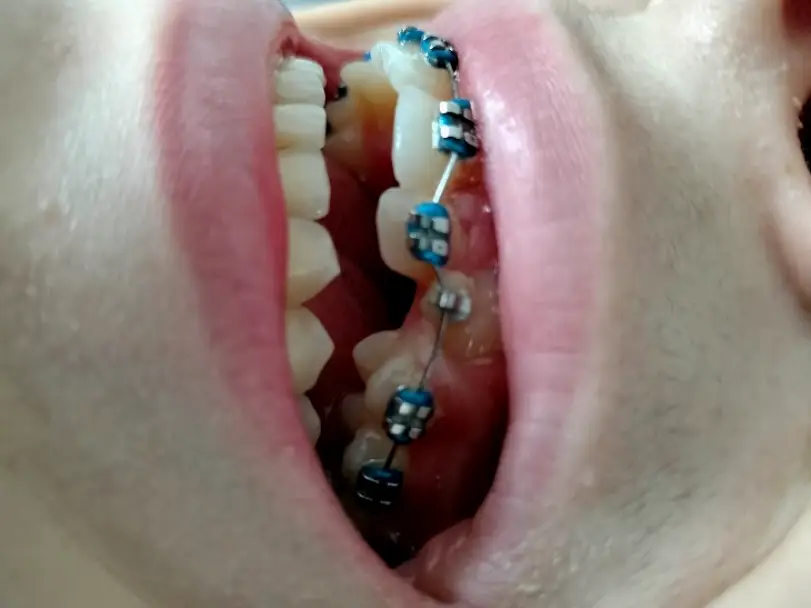 Downers Grove Premier Orthodontics