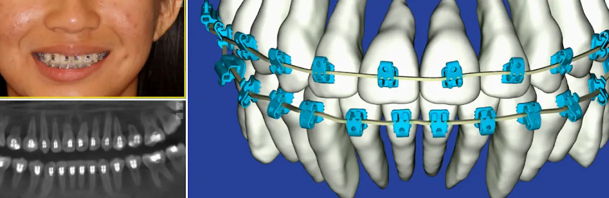 Stillwater Scissortail Orthodontics