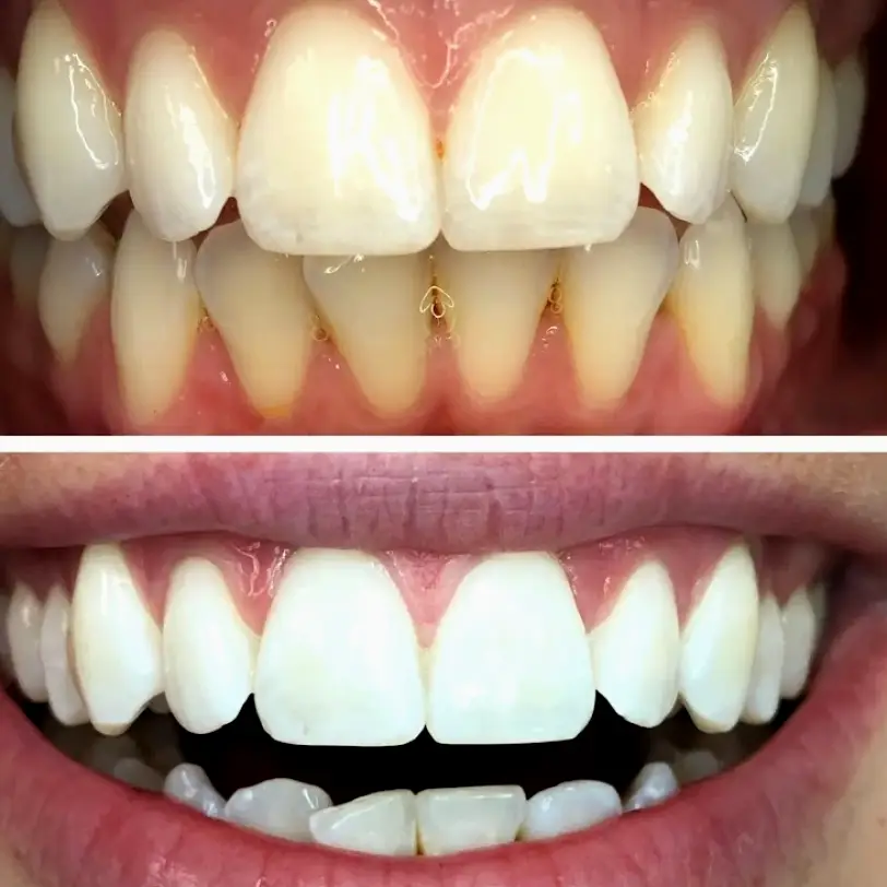  Lehi We Whiten Teeth Whitening