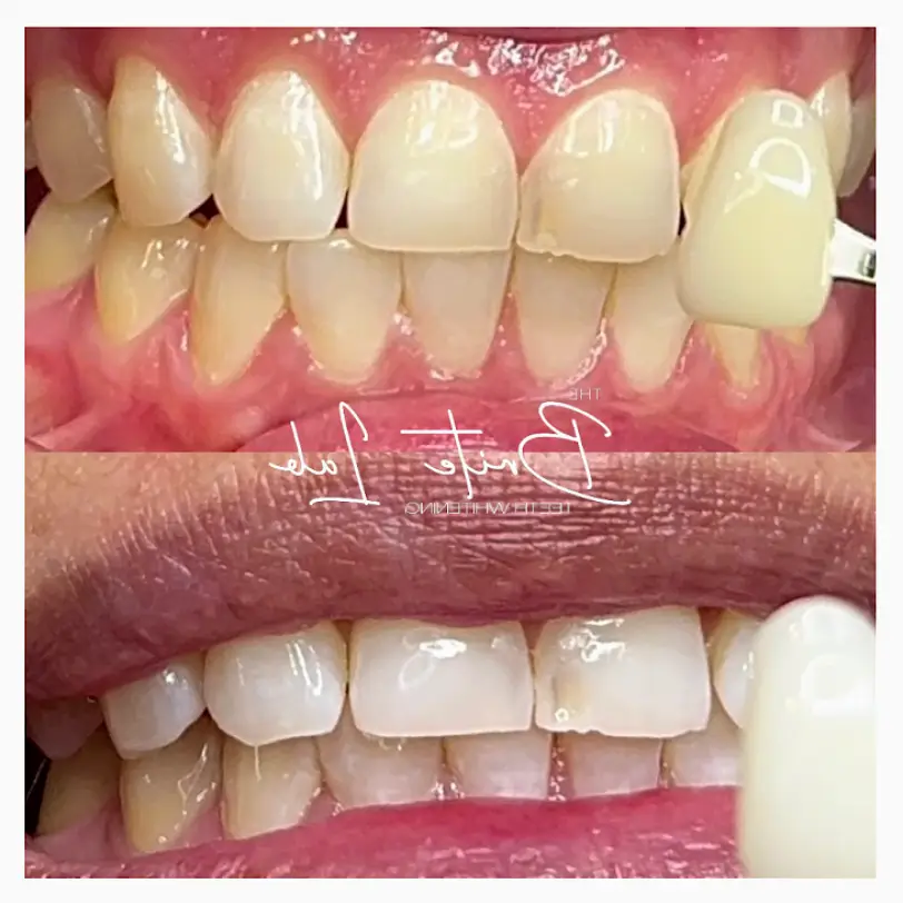 Grand Terrace The Brite Lab Teeth Whitening