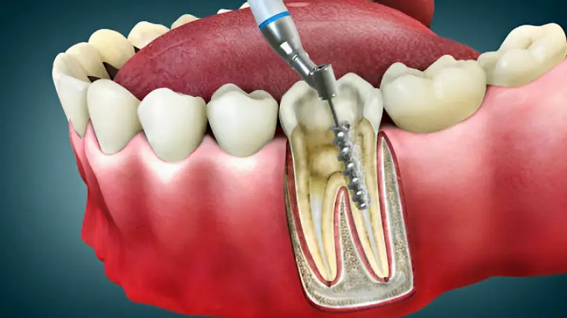 Mt Vernon Aurora Smiles- Amul G. Patel DDS, PC