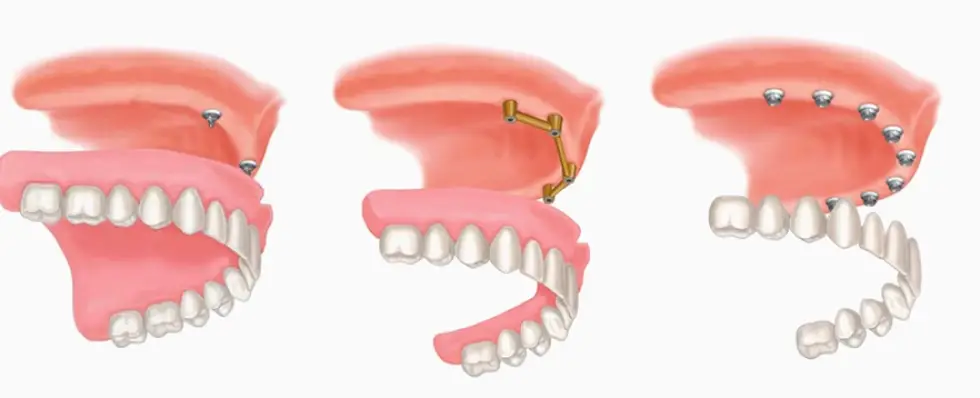 Clearfield Natural Fit Dentures & Denture Care Ogden-Layton