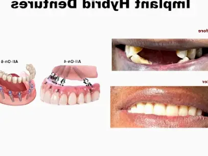 Brookhaven Dental implants and Cosmetic Dentistry