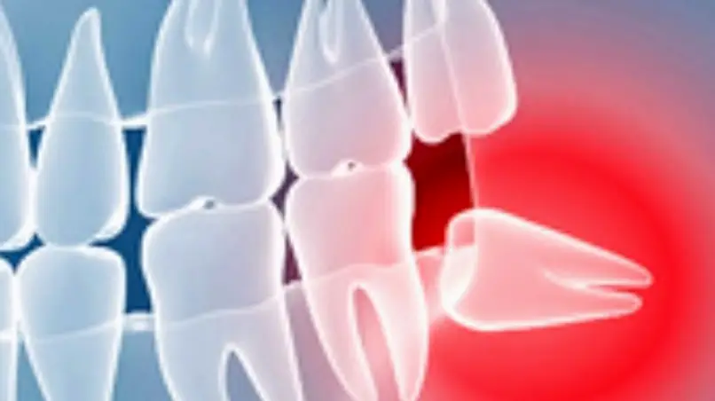 San Jose Silicon Valley Wisdom Teeth