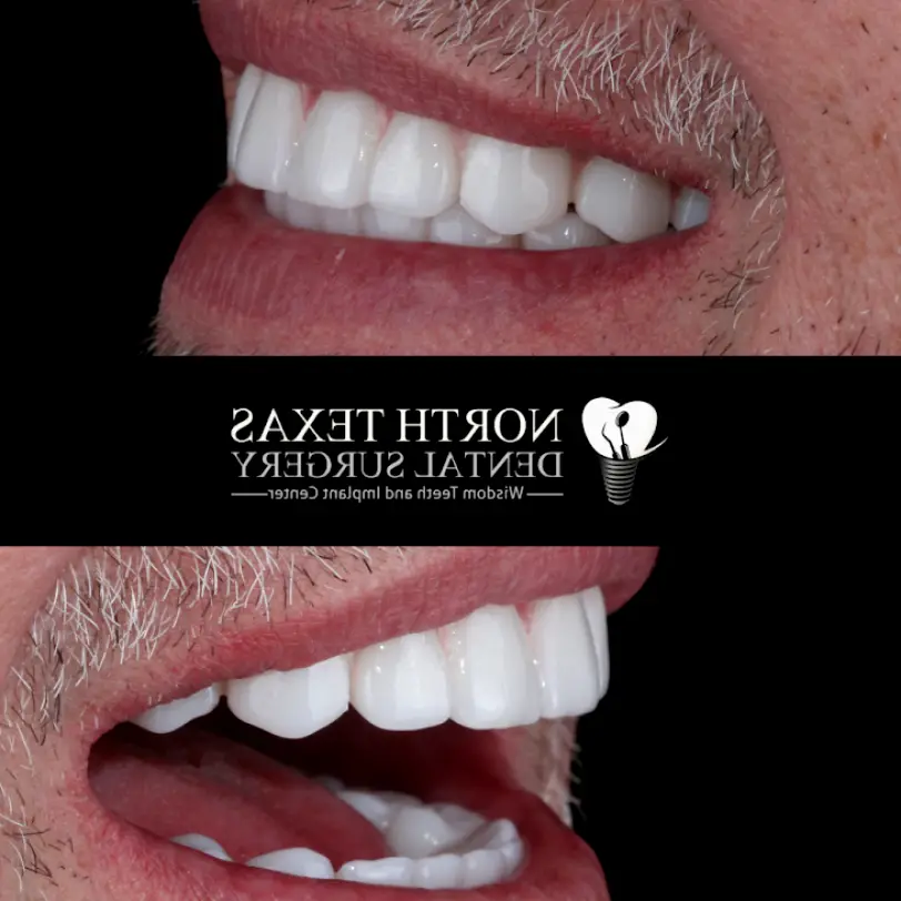 McKinney North Texas Dental Surgery Wisdom Teeth and Denture Implant Center