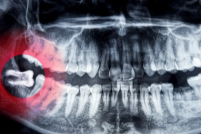 Santa Rosa Wisdom Teeth Removal