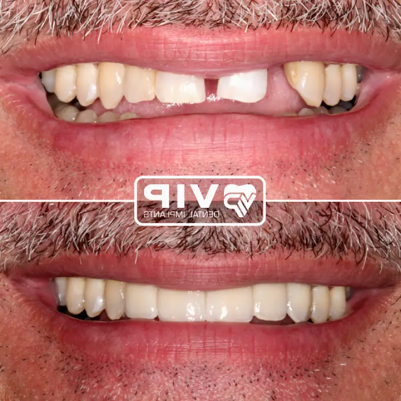 Afton Oaks / River Oaks Area VIP Dental Implants Uptown