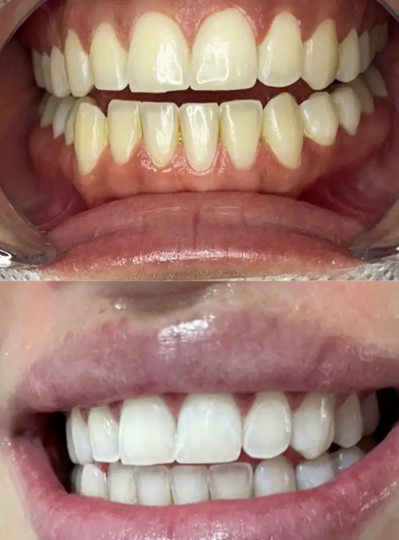 Ridgeland Luxury Smiles Teeth Whitening