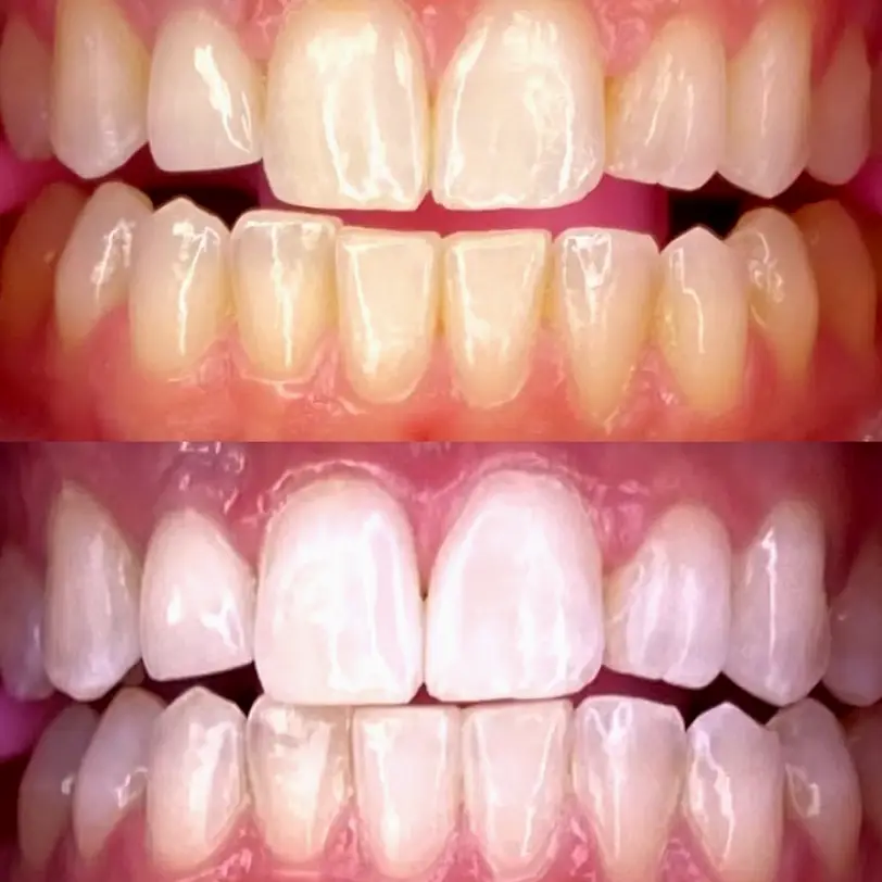 Nixa Shimmer Teeth Whitening
