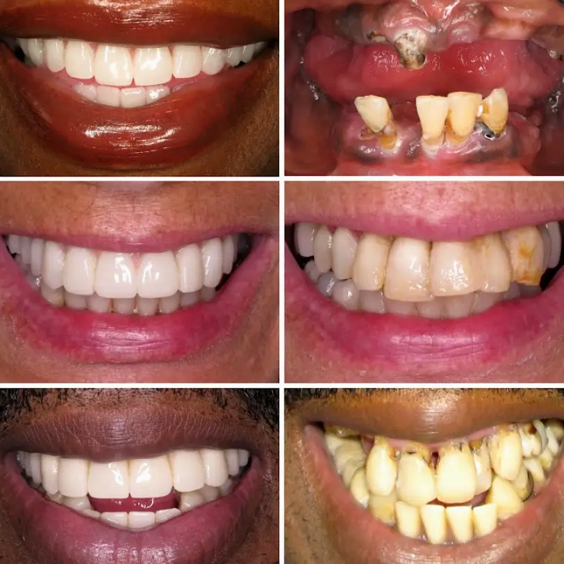 Nutley TeethNow Dental Implants New Jersey