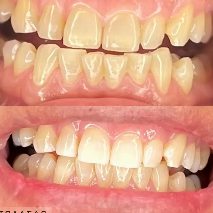 Hesperia Pearl Diamond smile