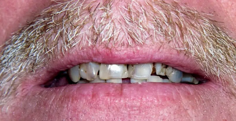 Sebring Mini Dental Implant Center