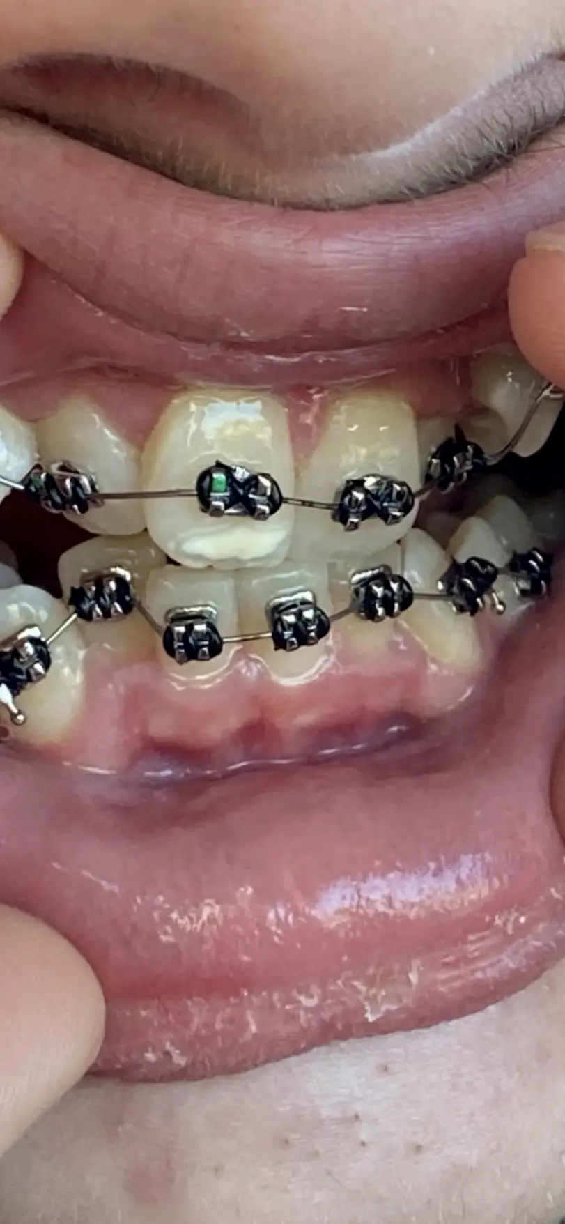 Bluefield Crowe & Company Orthodontics