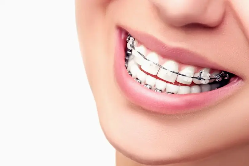 Idaho Falls Elison & Wood Orthodontics