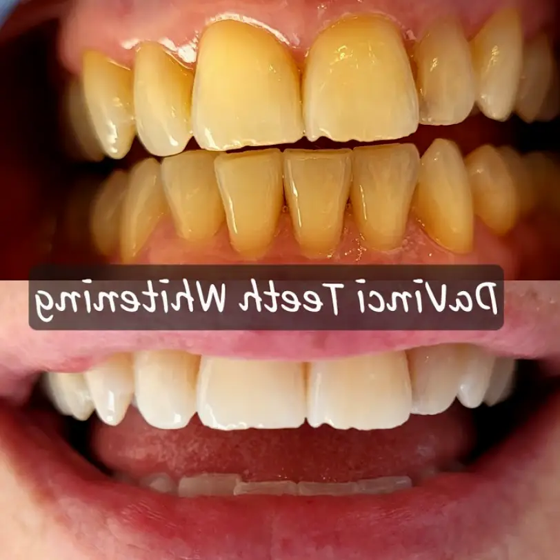 Sault Ste. Marie DaVinci Teeth Whitening Sault Ste.Marie