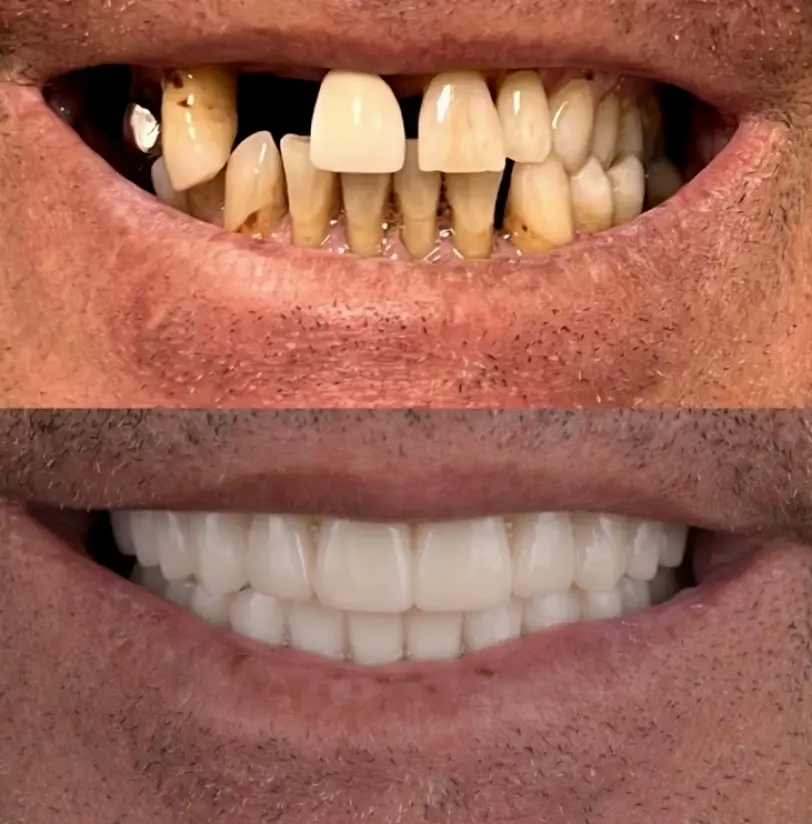  Tampa Dental Implants