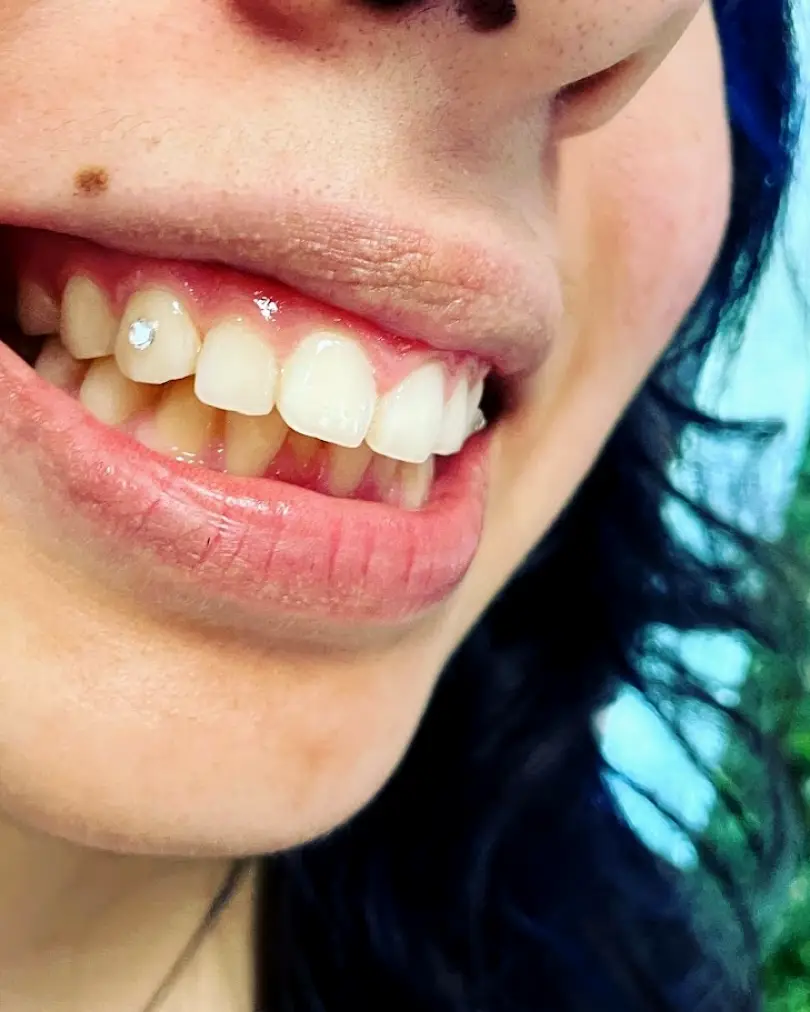 Tomball Truly Bright Teeth Whitening