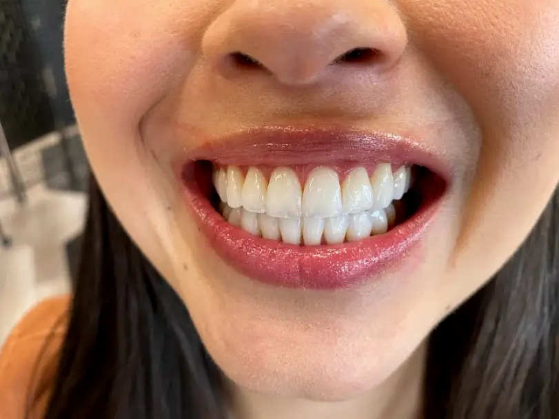 Silverdale Kitsap Whitening Clinic