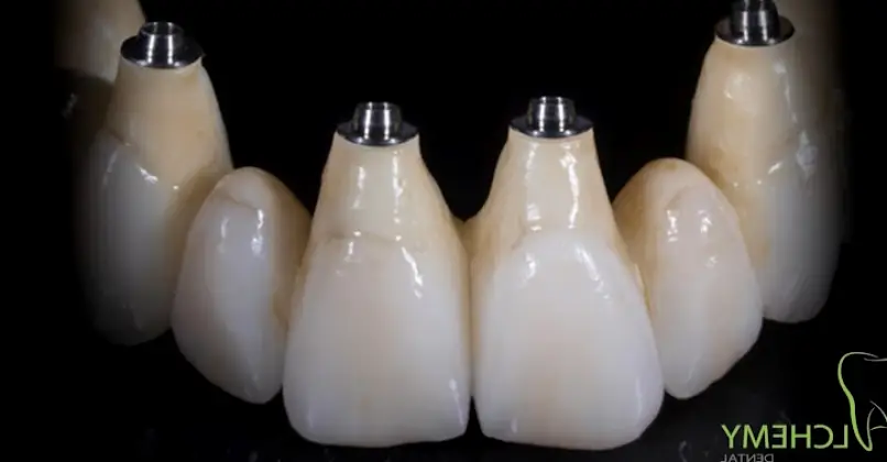 Teaneck Alchemy Implant Dental Lab