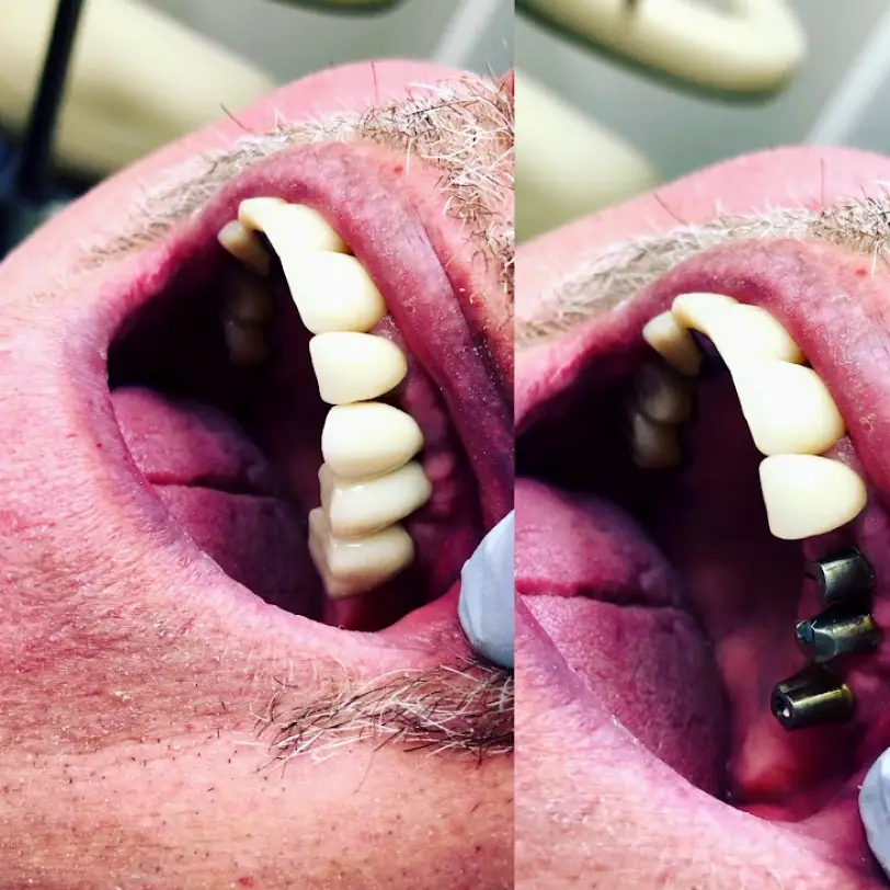 Troy smiles: Cosmetic and Implant Dentistry
