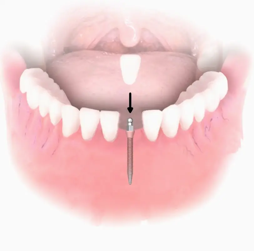 Rockwall Dental Implant Solutions