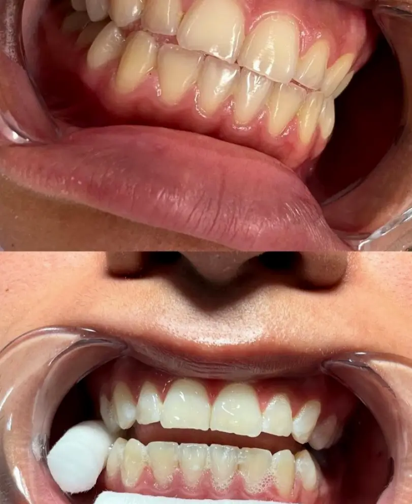 Beaumont Hollywood Smiles409 Cosmetic Teeth Whitening