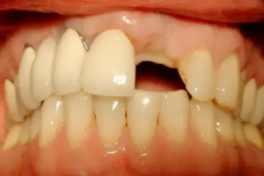 Surrey Smile Dental Implant Center - White Rock Dentists