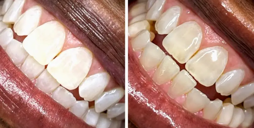 Marietta All White Teeth