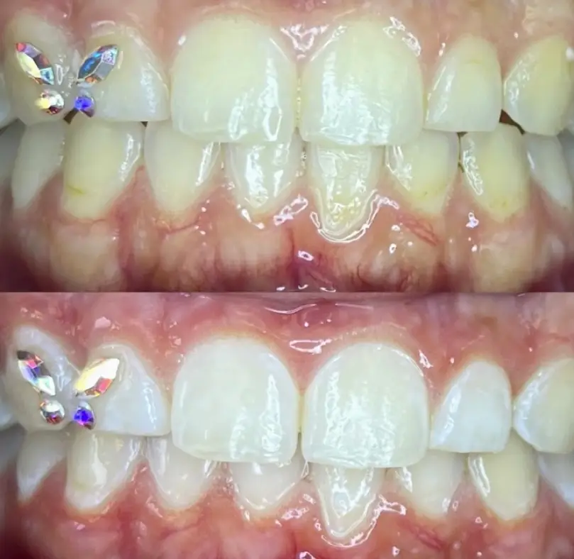 Fords Luna White Teeth Whitening & Tooth Gems