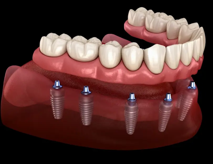 Leawood Gordon Dental Implants and Cosmetics