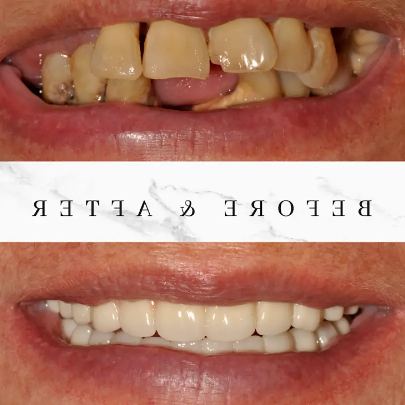 Lee's Summit Summit Implant Dentistry of Kansas City