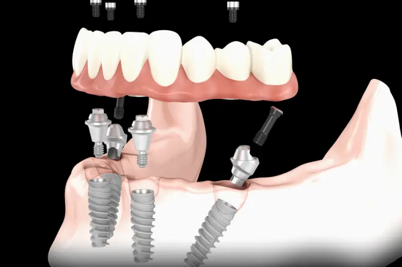 Sanger Implants