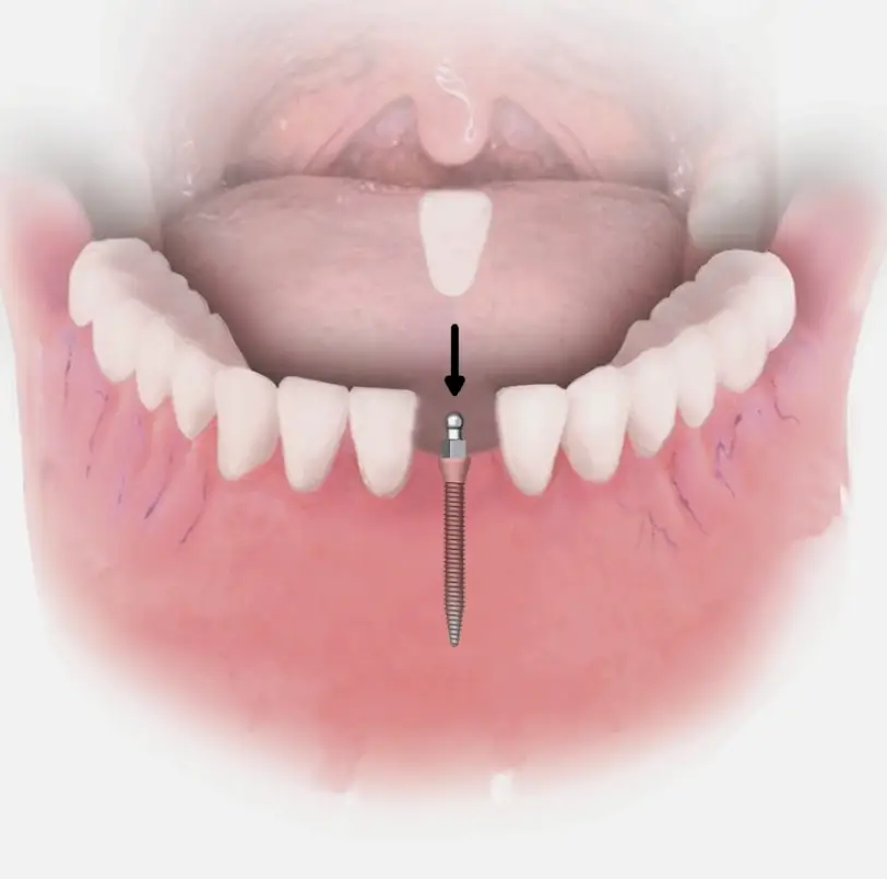 Dental Implant Solutions Summerfield, FL