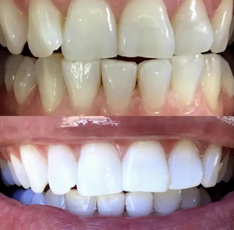 Afton Oaks / River Oaks Area Naturally White Teeth Whitening