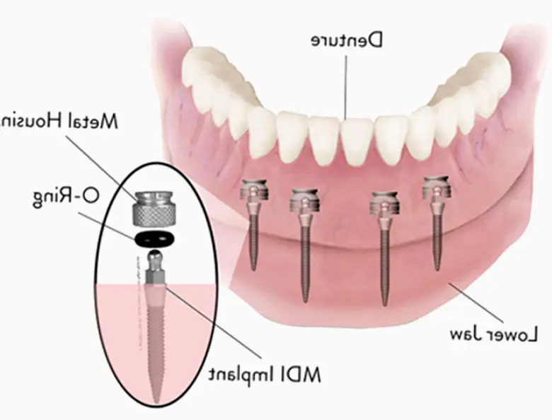 Dental Implant Solutions Eden, NY