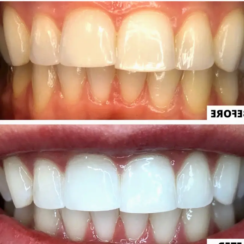 Allen We Whiten Teeth Whitening