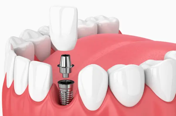 Sunrise Dental Sequim