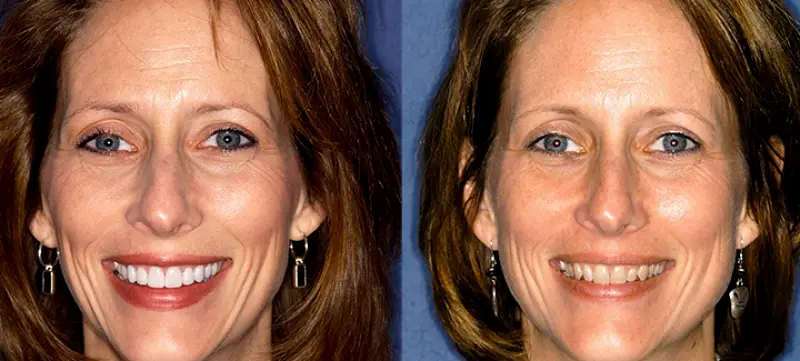 Lutke Dental - Plano