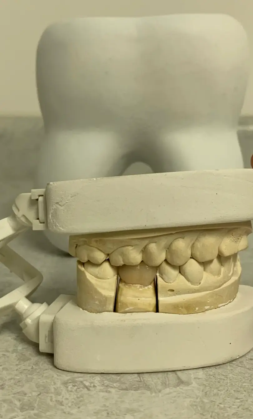 Los Algodones Dental Implants Mexico Dentali Dental Care - Dental Implants in los Algodones near Yuma AZ