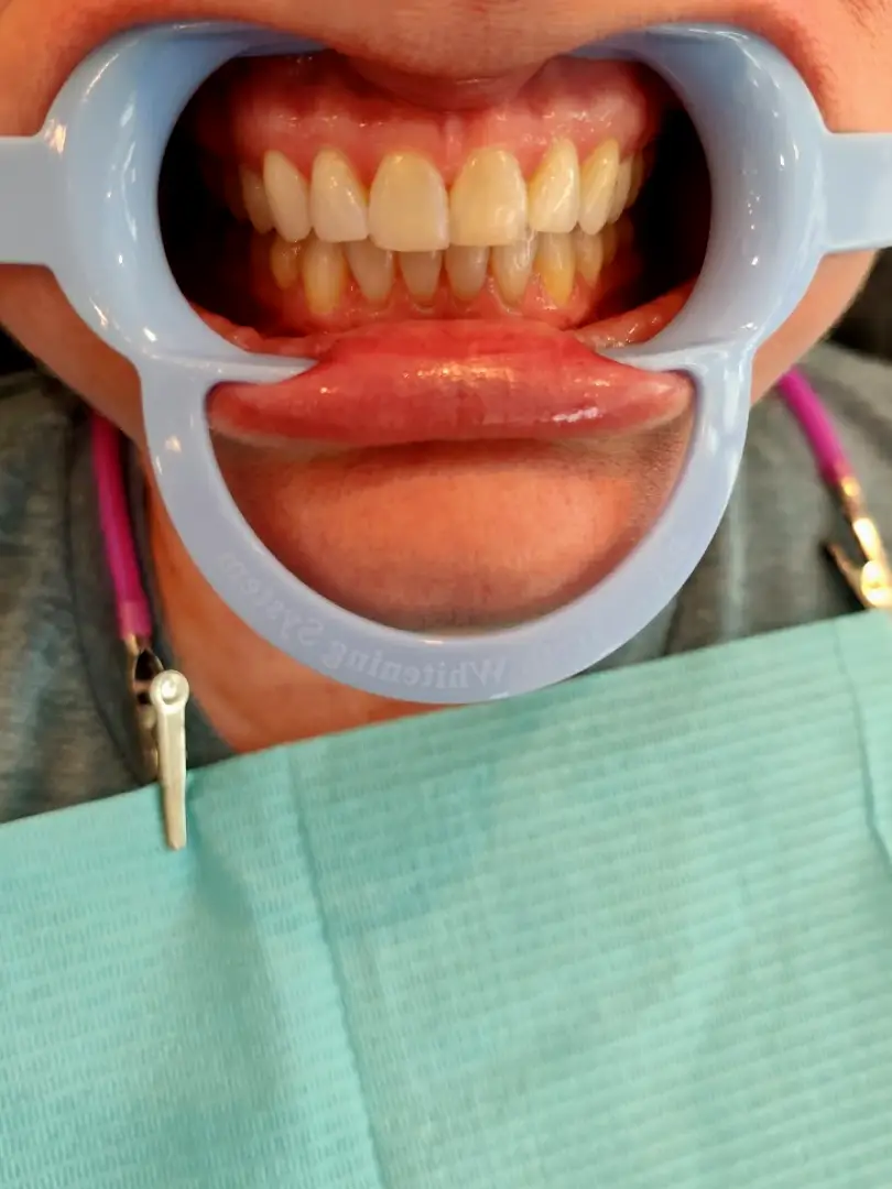 DaVinci Teeth Whitening of Venice